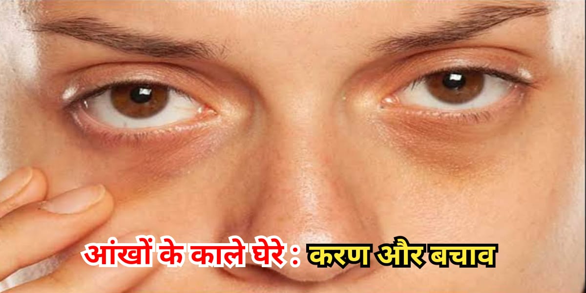 Dark Circles: आंखों के नीचे काले धब्बे क्यों होते हैं, यहां जानिए वजह और उपाय