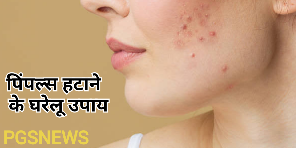 Face Pimples: मुँहासे को दूर करने के घरेलू उपाय, मुंहासे को करें आसानी से दूर